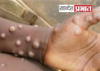 संकट : जगात मंकीपॉक्सचे थैमान ; भारतात आरोग्य यंत्रणा अलर्ट