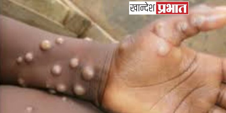 संकट : जगात मंकीपॉक्सचे थैमान ; भारतात आरोग्य यंत्रणा अलर्ट